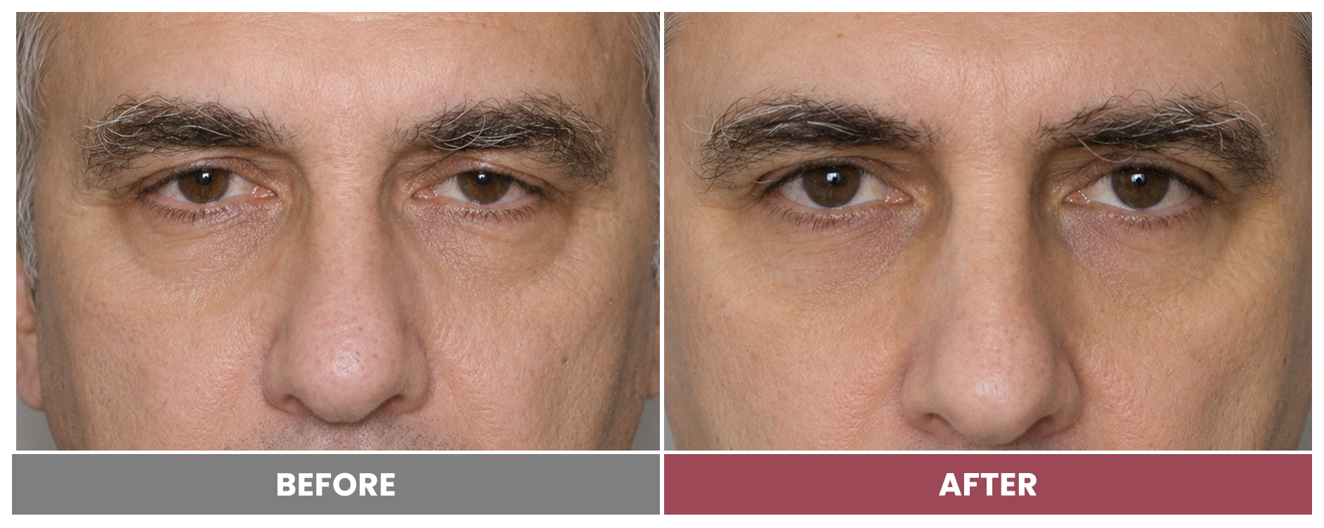 PTOSIS REPAIR - Case 48
